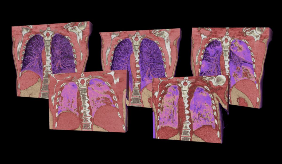 five phases of covid-19 lung CT scans